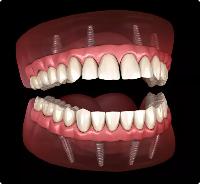Implant Supported Dentures