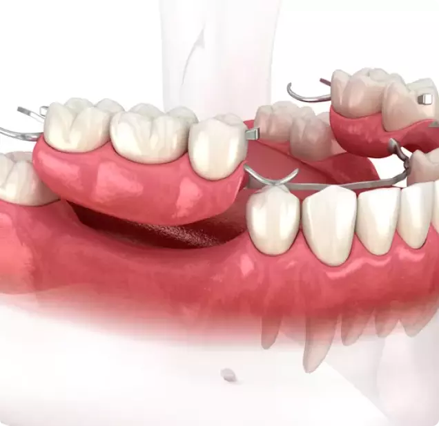 Final Prosthesis
