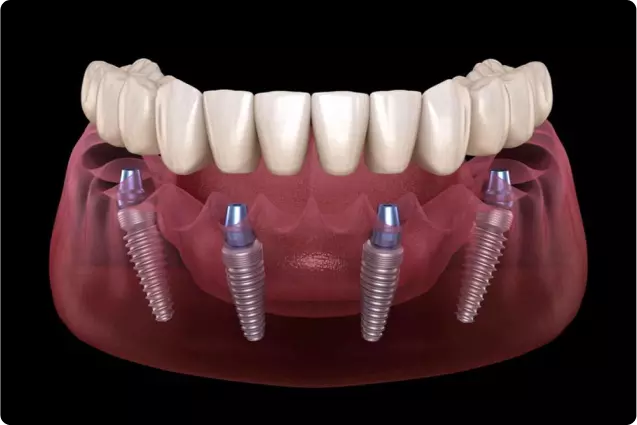 Multiple Implant