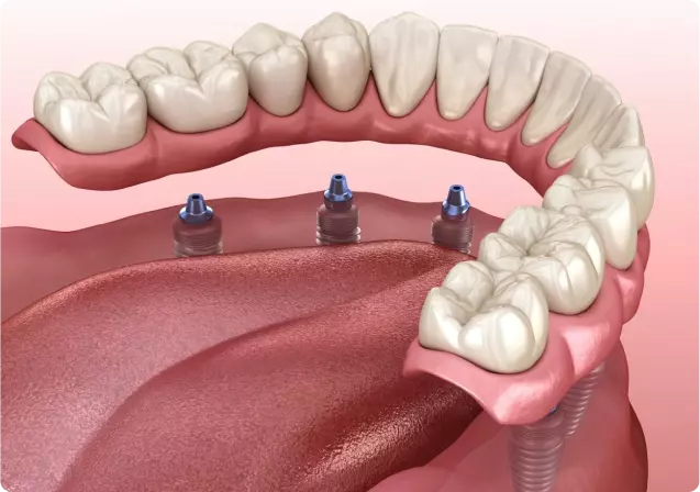All on 6/Dental Implants
